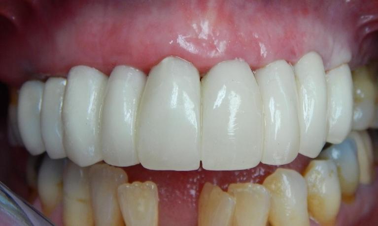 Full-Mouth-Restoration-After-Image