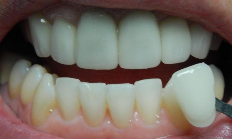 Professional-Teeth-Whitening-After-Image