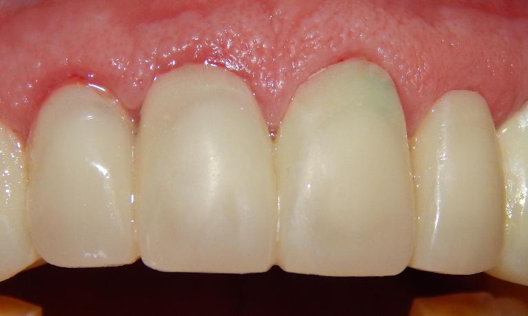 Porcelain-Bridge-After-Image