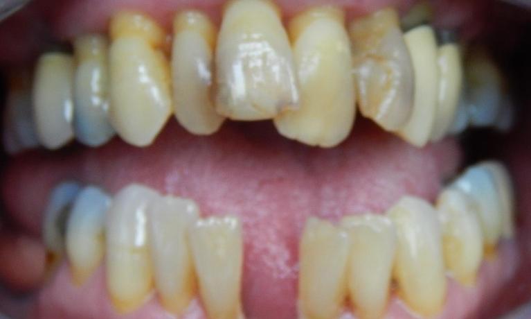 Full-Mouth-Restoration-Before-Image