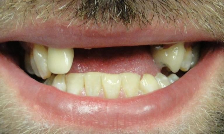 Implants-Before-Image