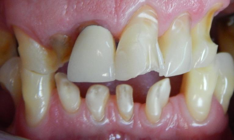 Porcelain-Bridge-Before-Image