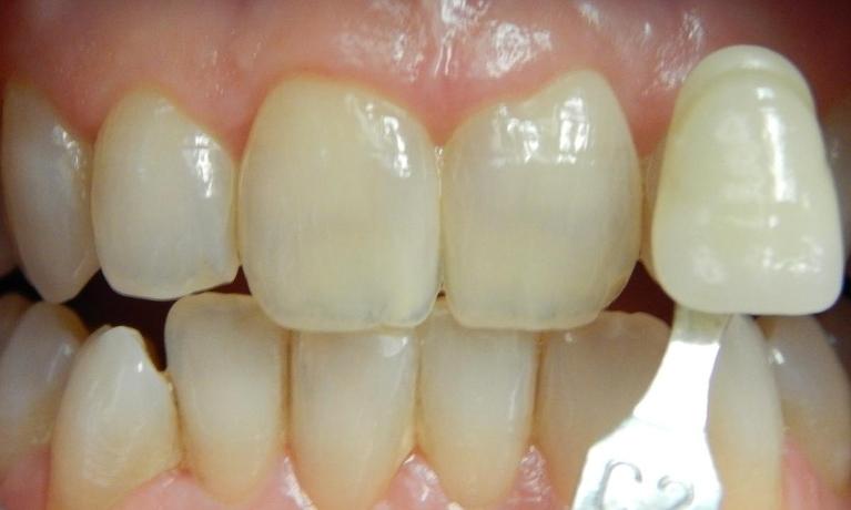 Professional-Teeth-Whitening-Before-Image