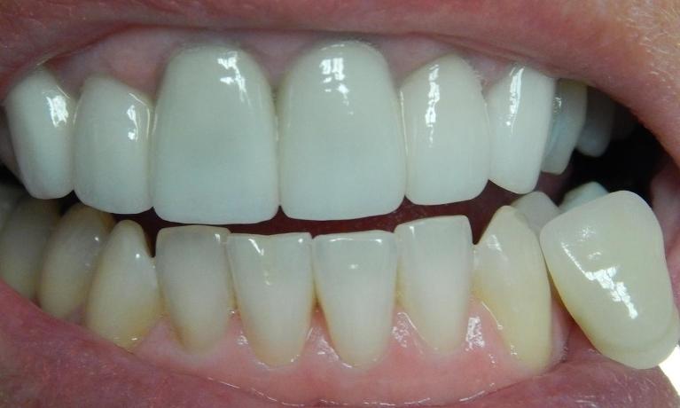 Professional-Teeth-Whitening-Before-Image
